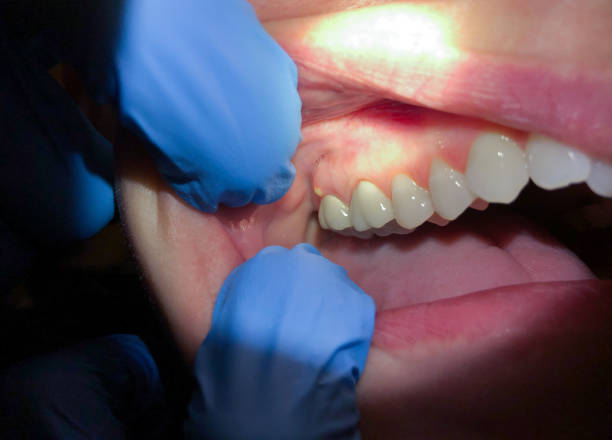 Best Emergency Tooth Extraction  in Maplewood, MO